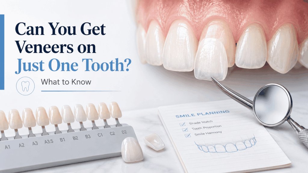 Can You Get Veneers on Just One Tooth