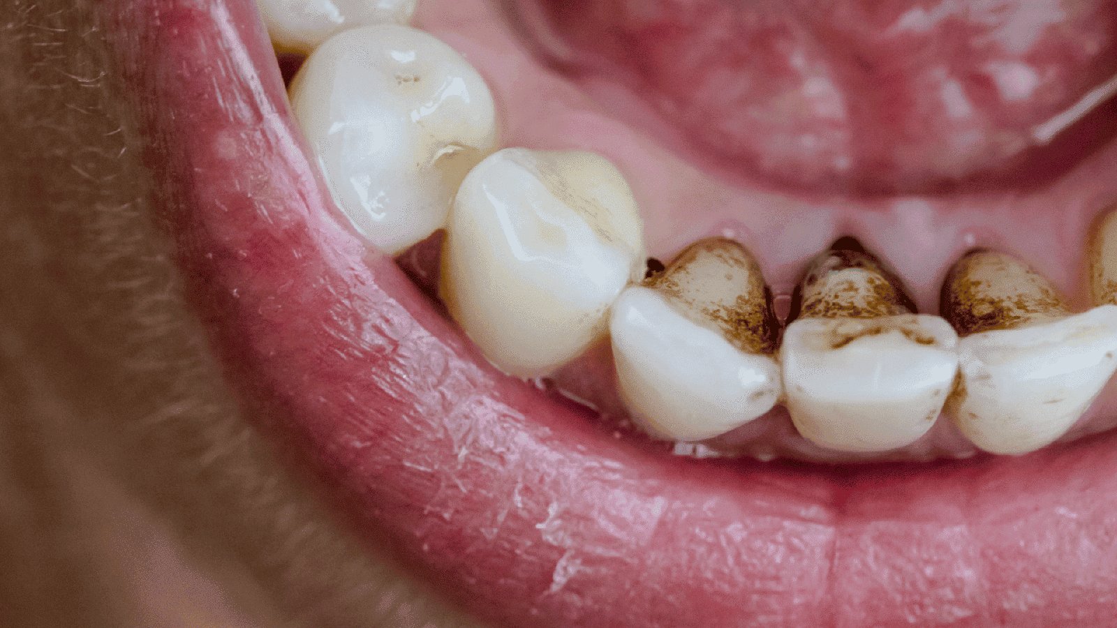 teeth stain image