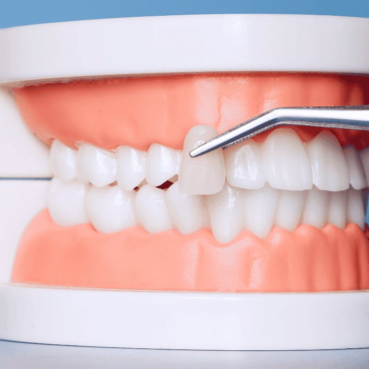 Dental veneer process image