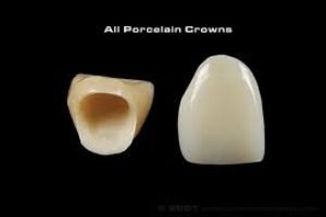 /wp-content/uploads/2018/05/crown2-300x200.jpg